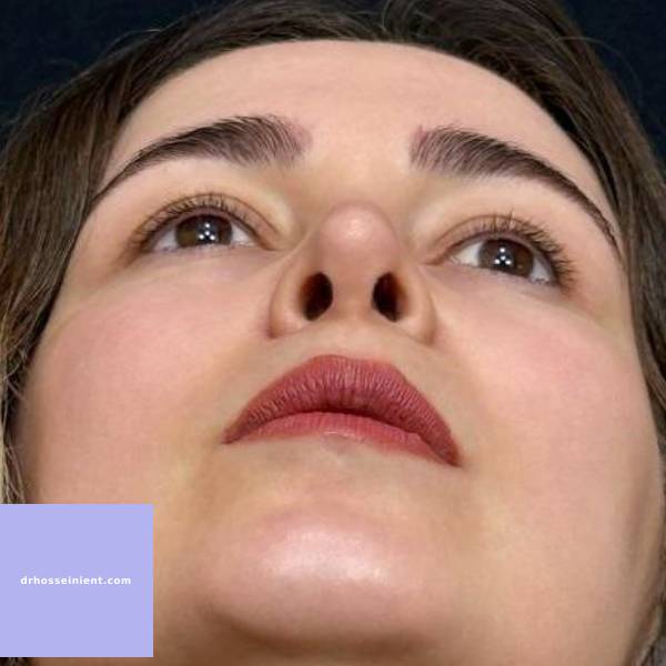 عکس جراحی زیبایی بینی- دکتر محمد علی حسینی - drhosseinient.com