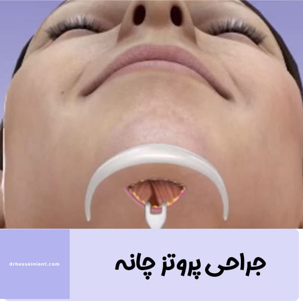 عکس عمل پروتز پانه - دکتر محمد علی حسینی - drhosseinient.com