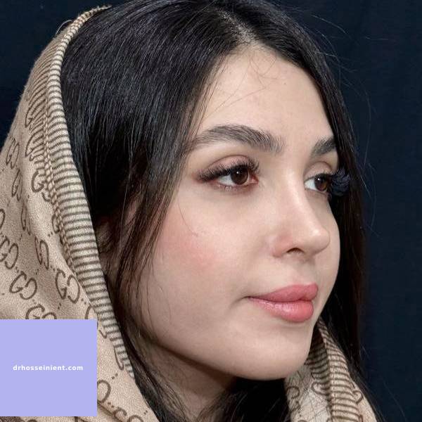 عکس بهترین مدل بینی- دکتر محمد علی حسینی - drhosseinient.com