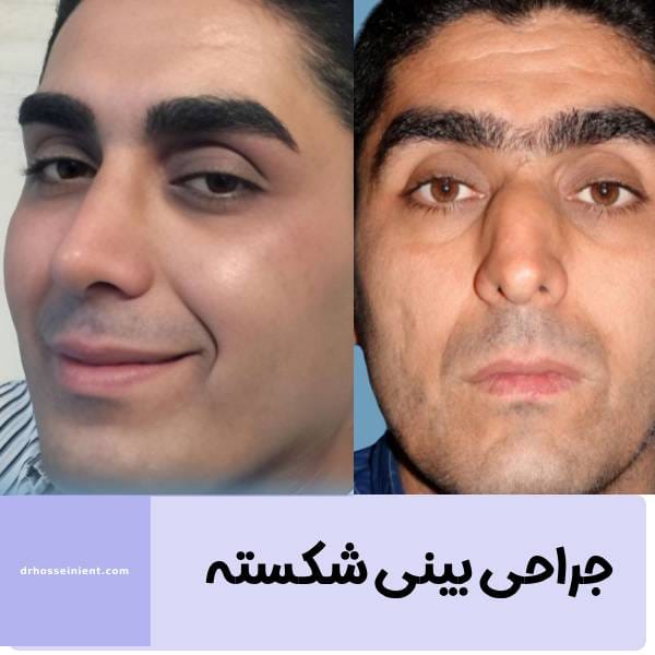 جراحی بینی شکسته