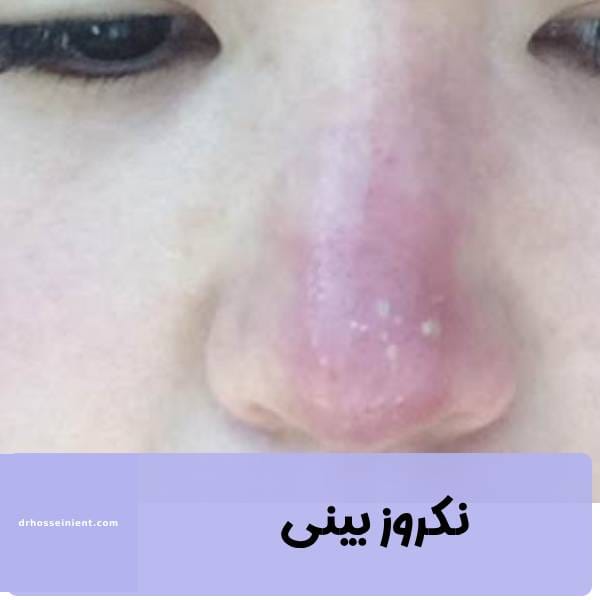 عکس نکروز بینی