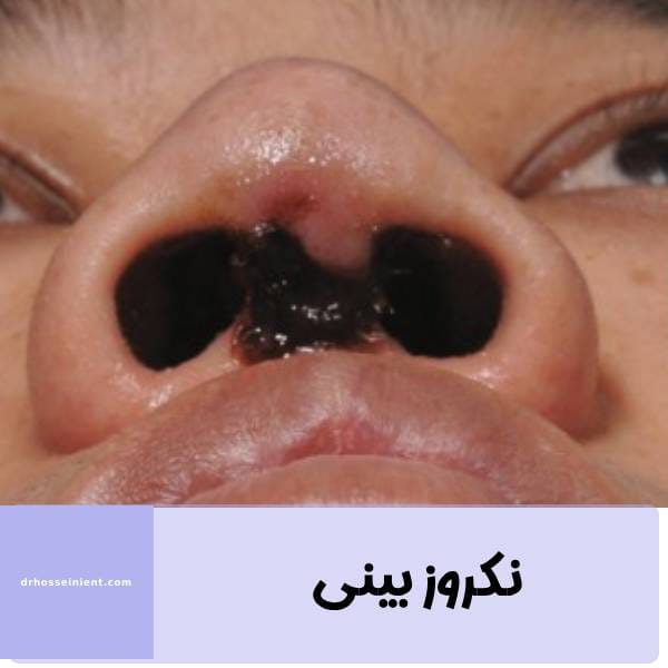 عکس بینی نکروز کرده