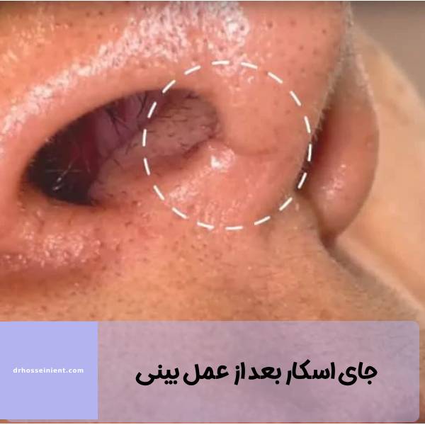 جای زخم بعد از جراحی بینی