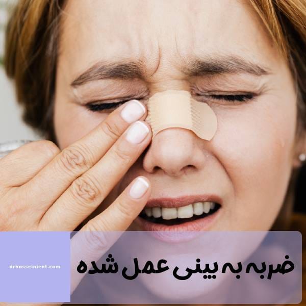 ضربه به بینی جراحی شده 