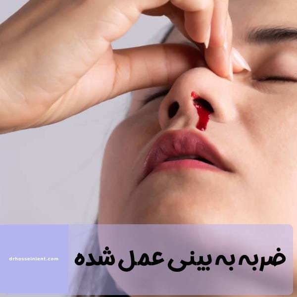 ضربه خوردن بینی بعد از جراحی