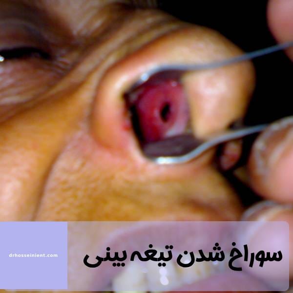 سوراخ سپتوم بینی