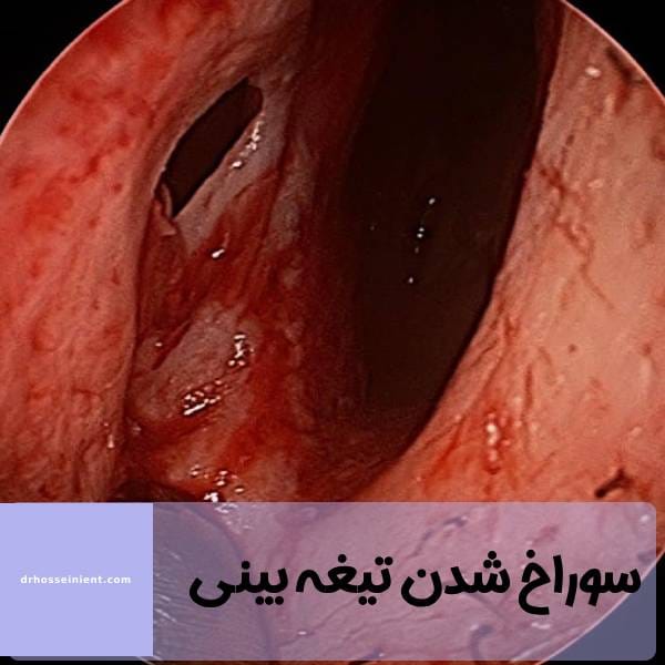 سوراخ شدن تیغه بینی