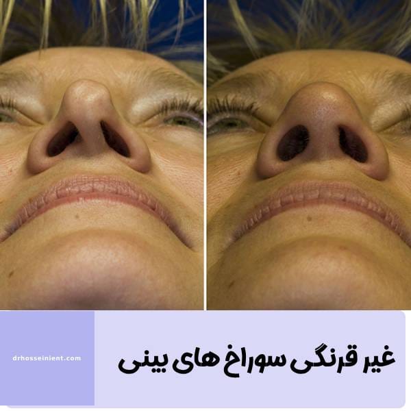 غیرقرینگی سوراخ های بینی