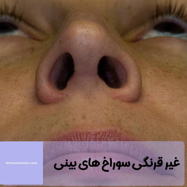 عدم تقارن سوراخ های بینی بعد از جراحی