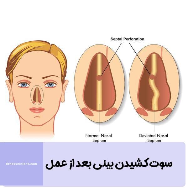 سوت کشیدن بینی بعد از عمل