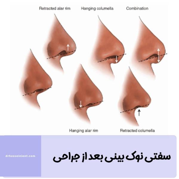 عکس سفتی نوک بینی بعد از عمل