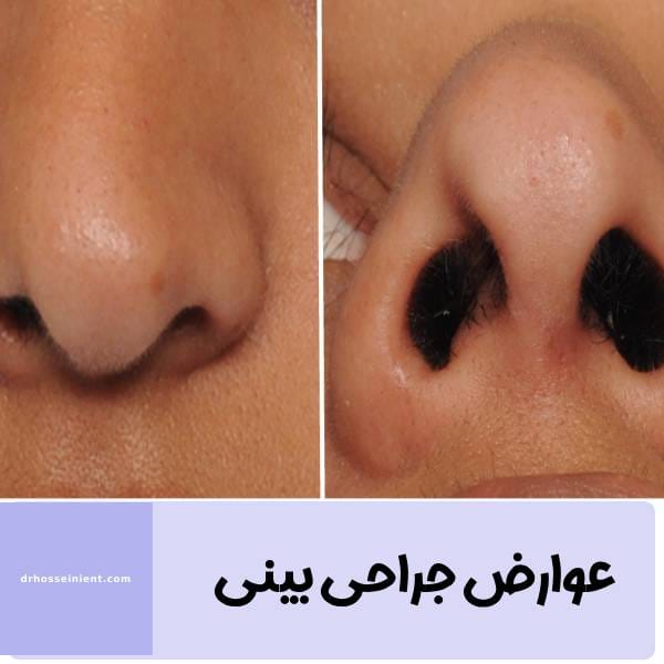 عوارض جراحی بینی