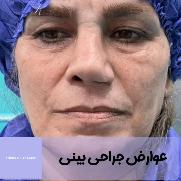 عوارض دراز مدت عمل بینی