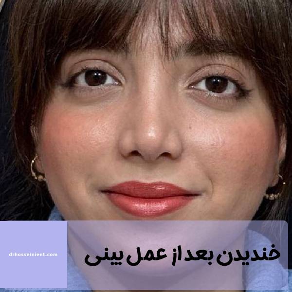 خندیدن بعد از عمل بینی