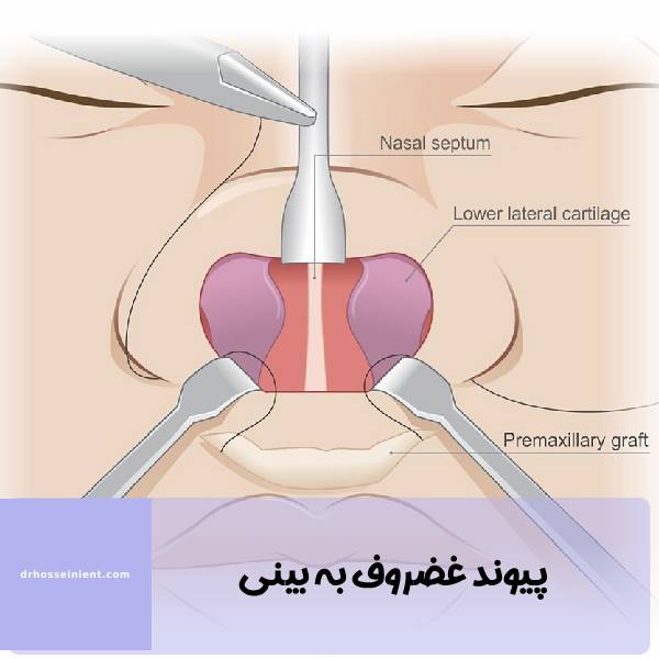 پیوند عضروف به بینی