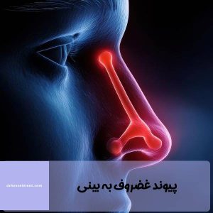 عمل پیوند عضروف به بینی