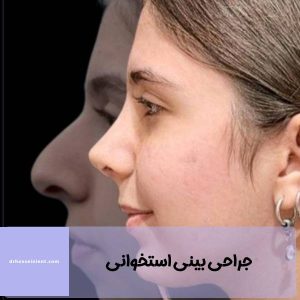 جراحی بینی استخوانی در اهواز