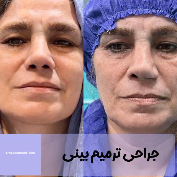 جراحی بینی ترمیمی در اهواز