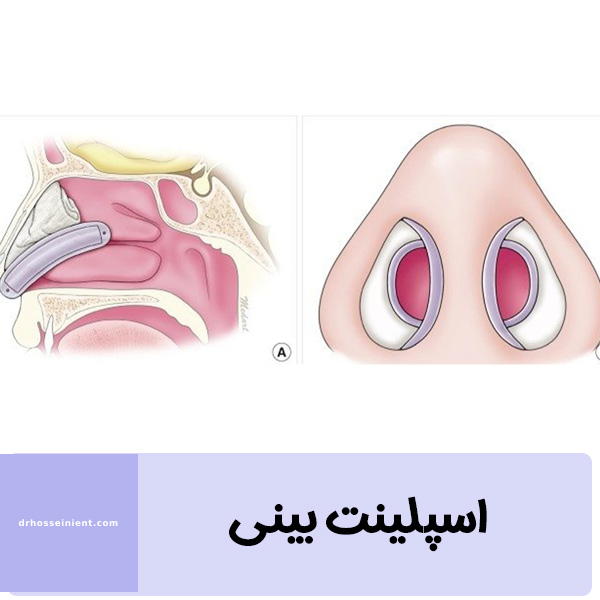 اسپلینت بینی