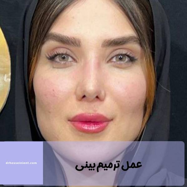 عکس عمل ترمیم بینی در اهواز