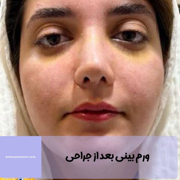 ورم بینی بعد از جراحی