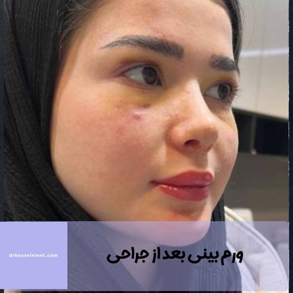 تورم بینی پس از عمل