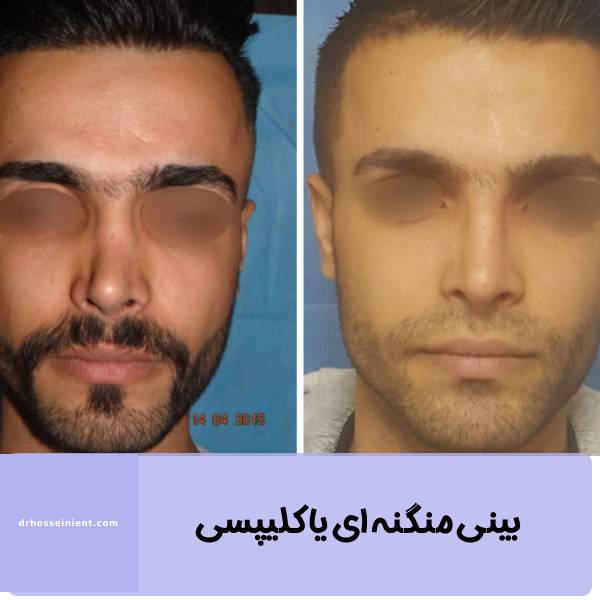 عمل بینی منگنه ای یا کلیپسی