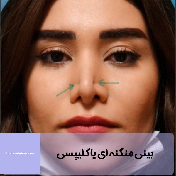 بینی منگنه ای یا پینچ نوز