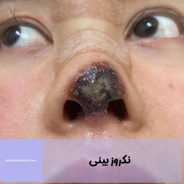 عکس نکروز بینی | دکتر محمدعلی حسینی جراح بینی در اهواز