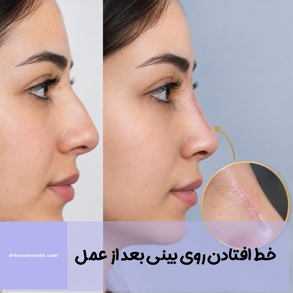 خط افتادن روی بینی بعد از عمل - دکتر حسینی