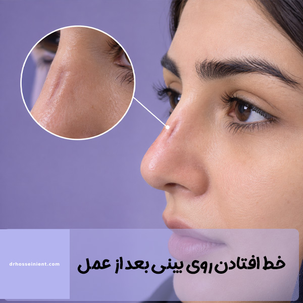 خط افتادن روی بینی بعد از عمل - دکتر حسینی