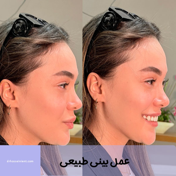 عمل بینی طبیعی - دکتر محمدعلی حسینی
