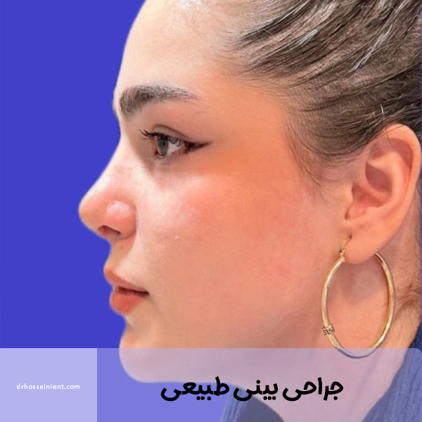 جراحی بینی طبیعی در اهواز - دکتر محمدعلی حسینی