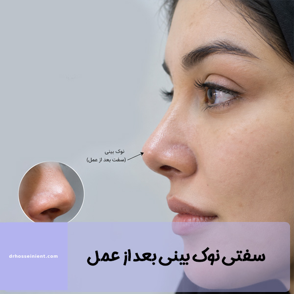 سفتی نوک بینی بعد از عمل - دکتر حسینی
